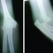 Figure 1: Anterior postior and lateral radiograph showing dislocation